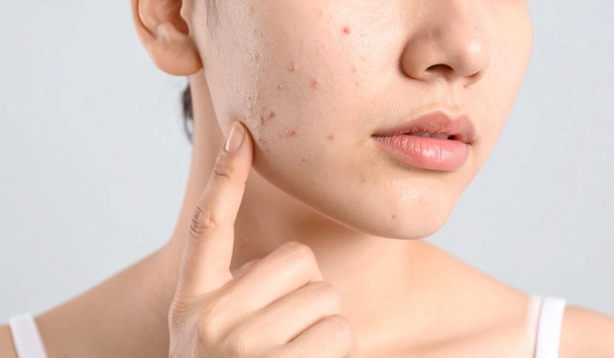 Güneş Lekeleri: Neden Oluşur, Nasıl Geçer? En Etkili Çözümler